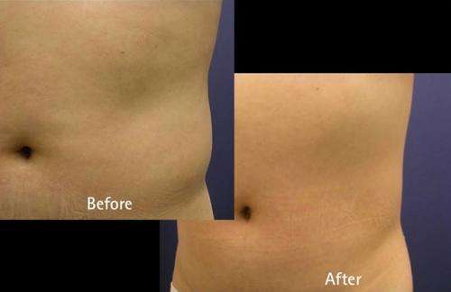 You can lose up to 18cm with our SELF HEATING Cellulite Bodywrap with each treatment!!!